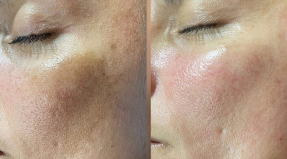 Huidresultaat voor en na een microneedlingbehandeling